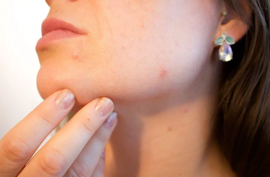Moisturizer for Acne-prone skin