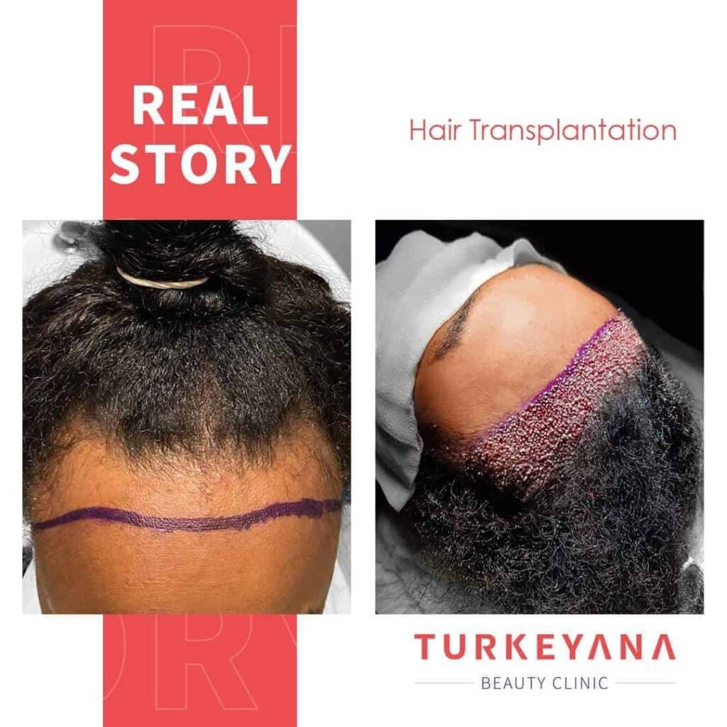 Hair Transplant Method