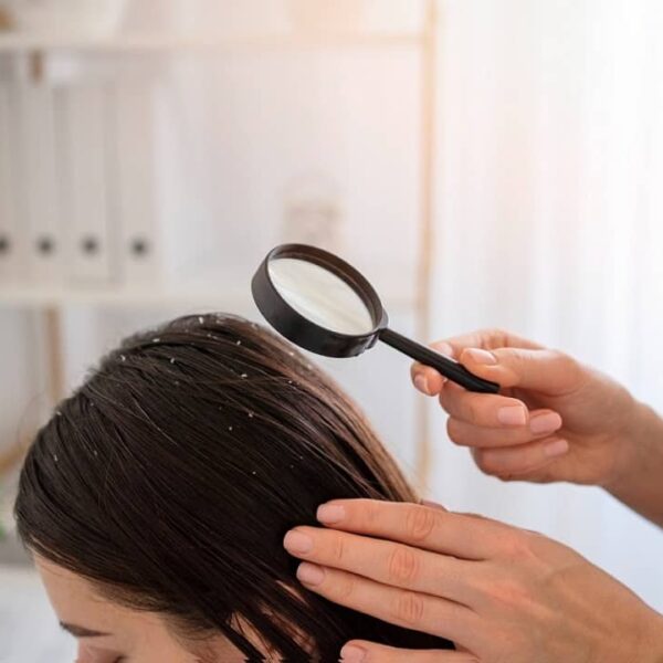 Home Remedies to Get Rid of Dandruff