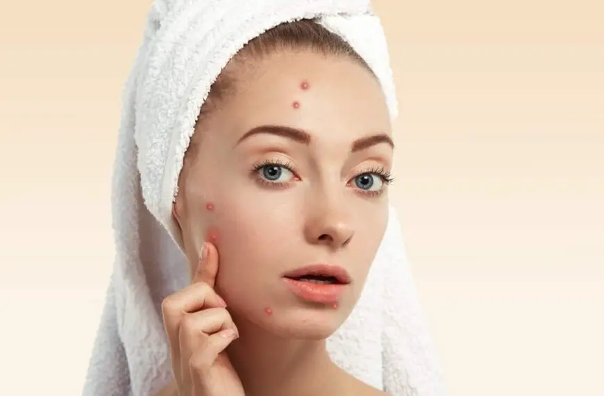 The Best Acne Skin Care Products & Treatment