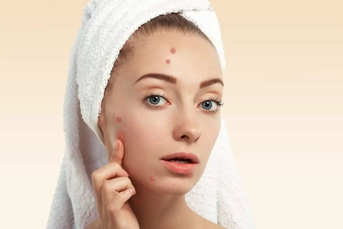 Acne Skin Care Products