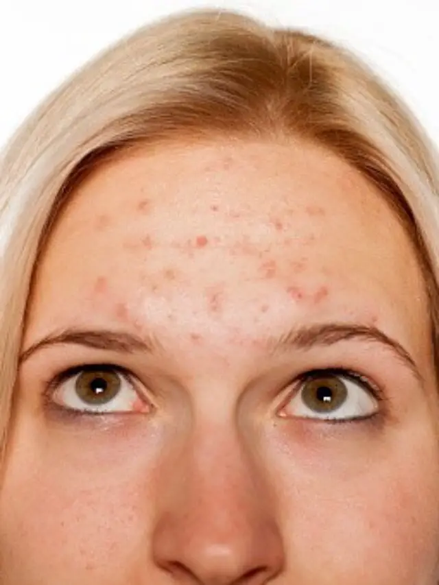 How to Get rid of Forehead Acne Fast – Secret tips no one tells you