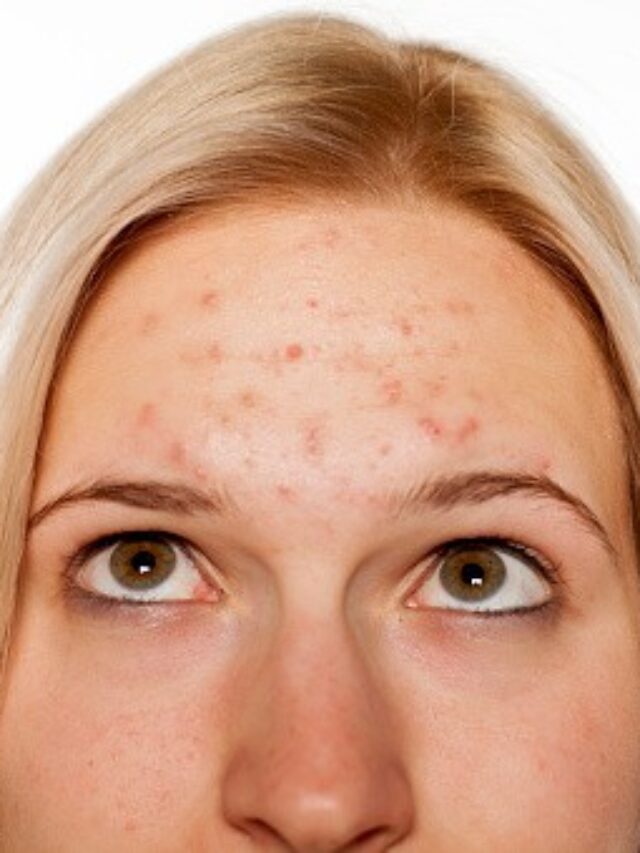 How to Get Rid of Forehead Acne