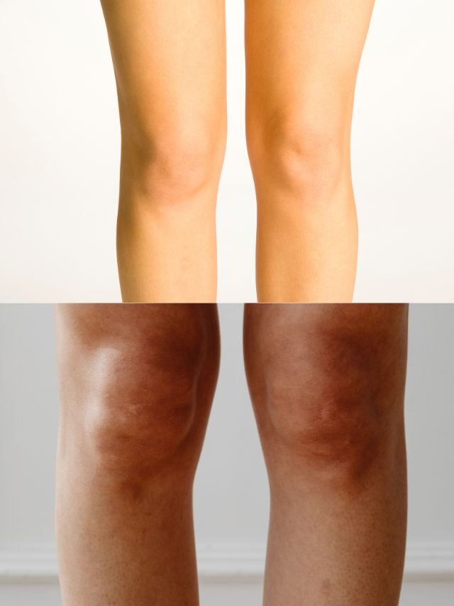 How to Get Rid of Dark Knees naturally
